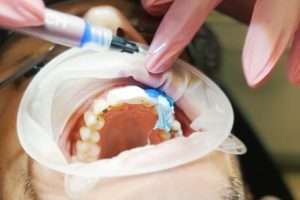 Can You Use a Take-Home Whitening Kit on Crowns or Veneers - StormDental