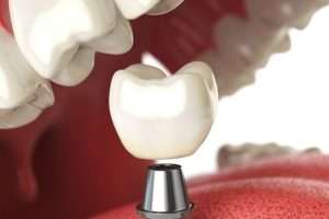 Can You Use a Take-Home Whitening Kit on Crowns or Veneers - StormDental