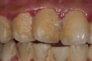 How Professional Scaling Protects Your Teeth and Gums Long-Term - StormDental