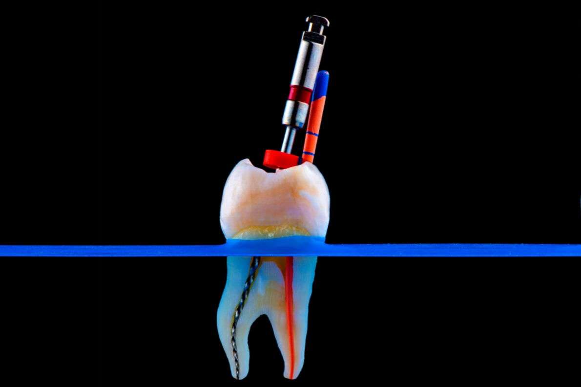 Can a Root-Treated Tooth Last a Lifetime?