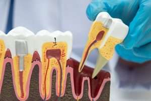 What Happens to the Jawbone After a Tooth Is Extracted - StormDental