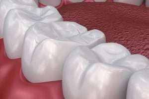 What Is a White Filling and How Does It Compare to Amalgam - StormDental