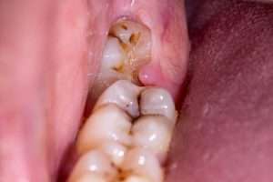 When Do Wisdom Teeth Need to Be Extracted - StormDental