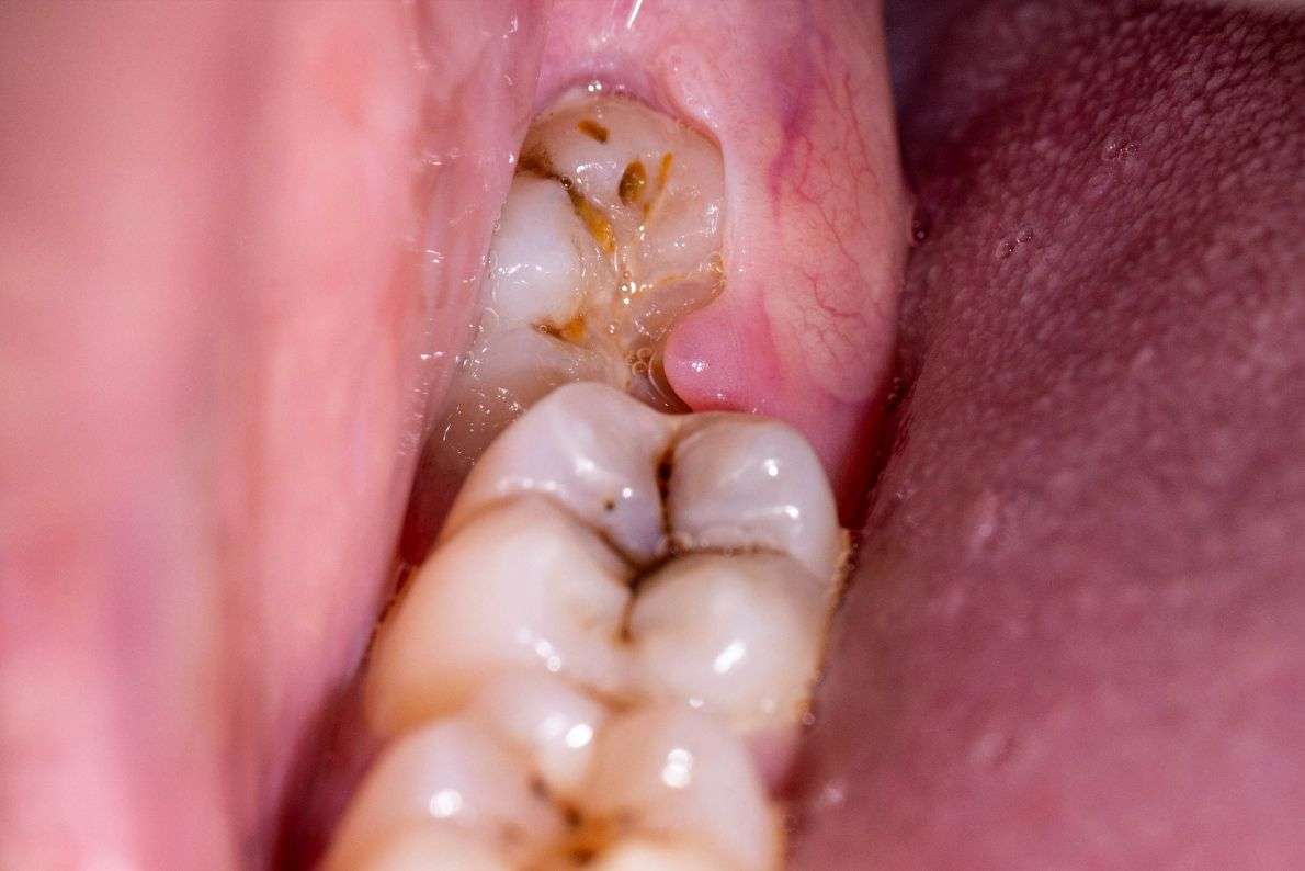 When Does a Wisdom Tooth Need to Be Extracted?
