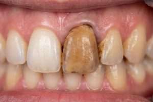 Who Is a Good Candidate for Take-Home Tooth Whitening - StormDental