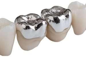 Porcelain vs Metal Crowns Which Is the Right Choice for You - StormDental