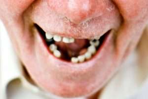 Can Dentures Improve Your Facial Appearance - StormDental