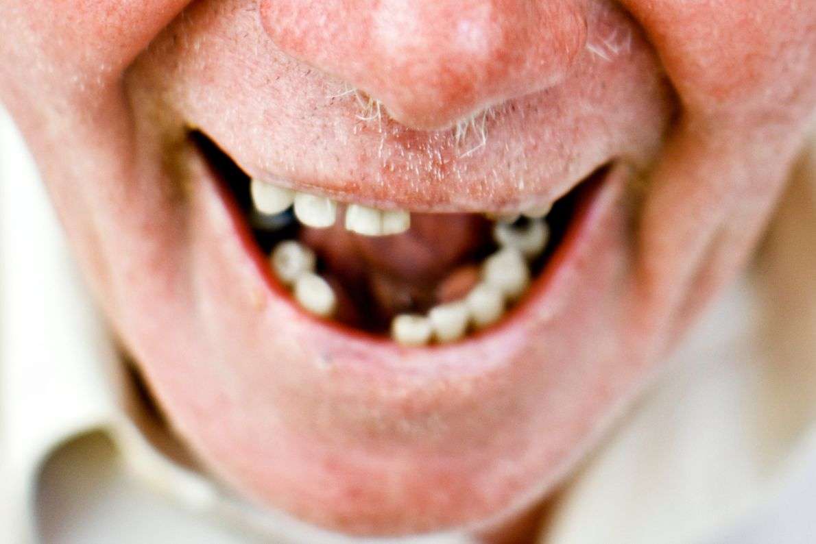 Can Dentures Improve Your Facial Appearance?
