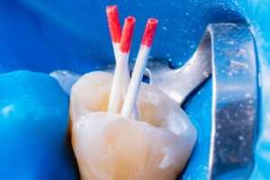 How Many Appointments Does Root Canal Treatment Require - StormDental