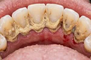 What Is Tartar and How Does a Scale and Polish Remove It - StormDental