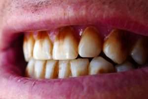 Can a Scale and Polish Remove Stains from Your Teeth - StormDental