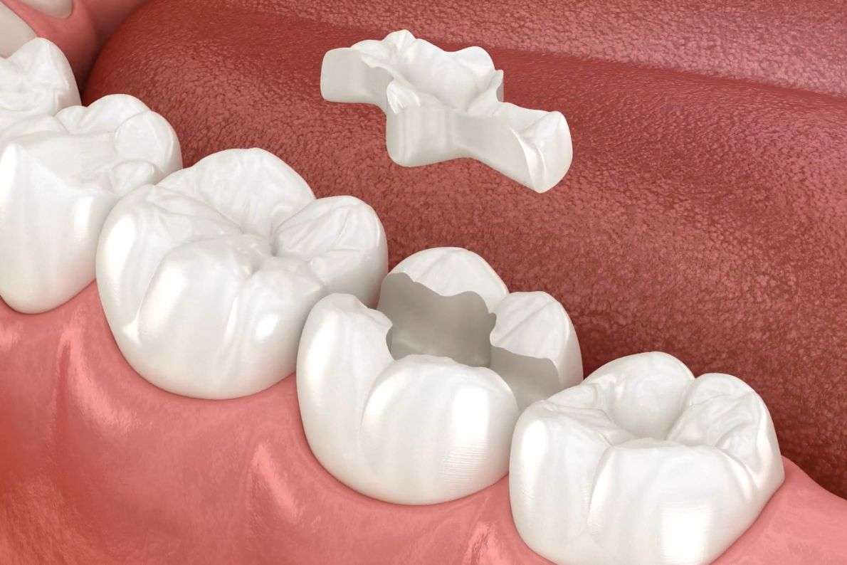 White Fillings vs Porcelain Inlays: Which Is Right for You?