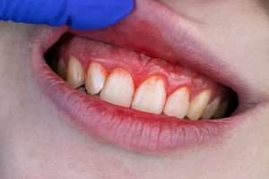 How a Scale and Polish Can Help Prevent Gum Disease - StormDental