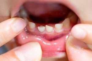 Root Canal Treatment for Children What Parents Need to Know - StormDental