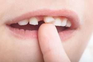 Tooth Extraction for Children What Parents Should Know - StormDental