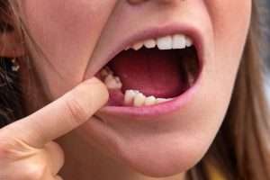 Why Skipping Your Scale and Polish Could Cost You More in the Long Run - StormDental