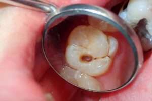 Why a Dental Crown Is Suitable for a Heavily Decayed Tooth - StormDental