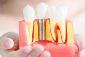 Can You Get Dental Implants on the NHS - StormDental