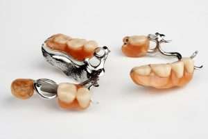 Can You Get Dental Implants on the NHS - StormDental