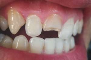 How Dental Crowns Restore Cracked or Broken Teeth - StormDental