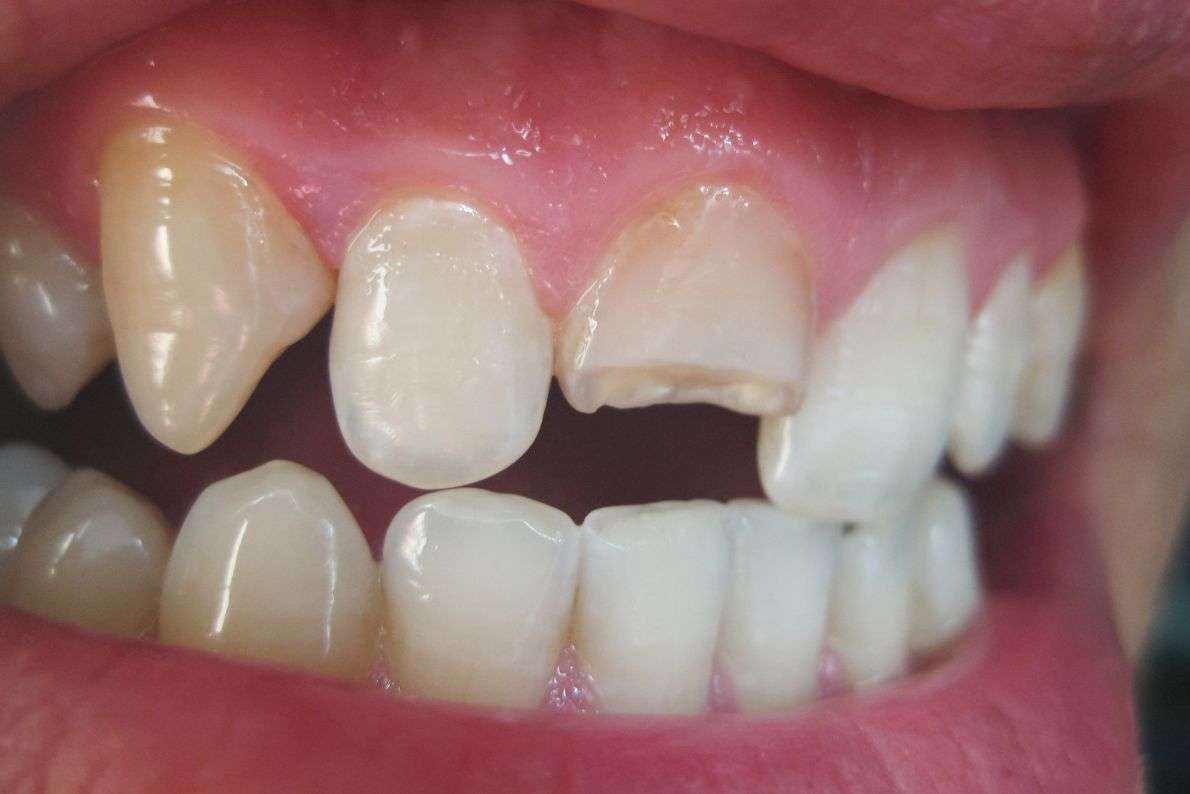 How Dental Crowns Restore Cracked or Broken Teeth