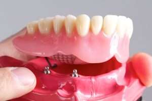 How to Fix Loose or Ill-Fitting Dentures - StormDental