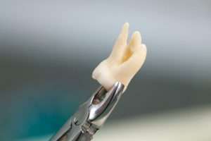 Root Canal Treatment vs Tooth Extraction - StormDental