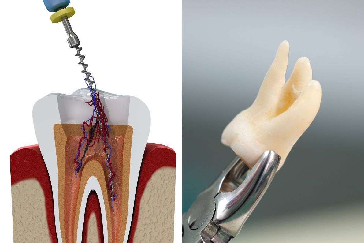 Root Canal Treatment vs Tooth Extraction: Which Is Preferrable?