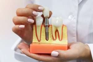What Are Your Tooth Replacement Options After an Extraction - StormDental