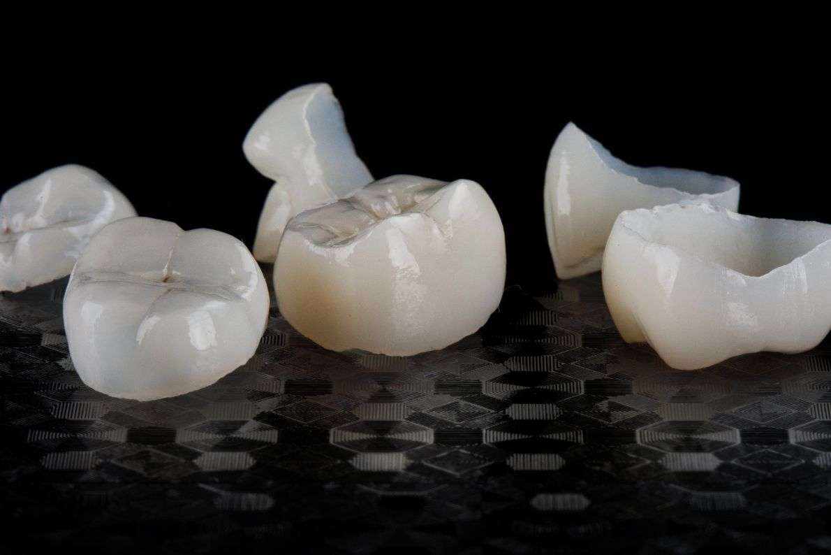 Are Dental Crowns Available on the NHS in Scotland?