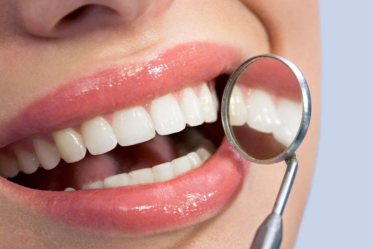 Are Take-Home Whitening Kits Available on the NHS?