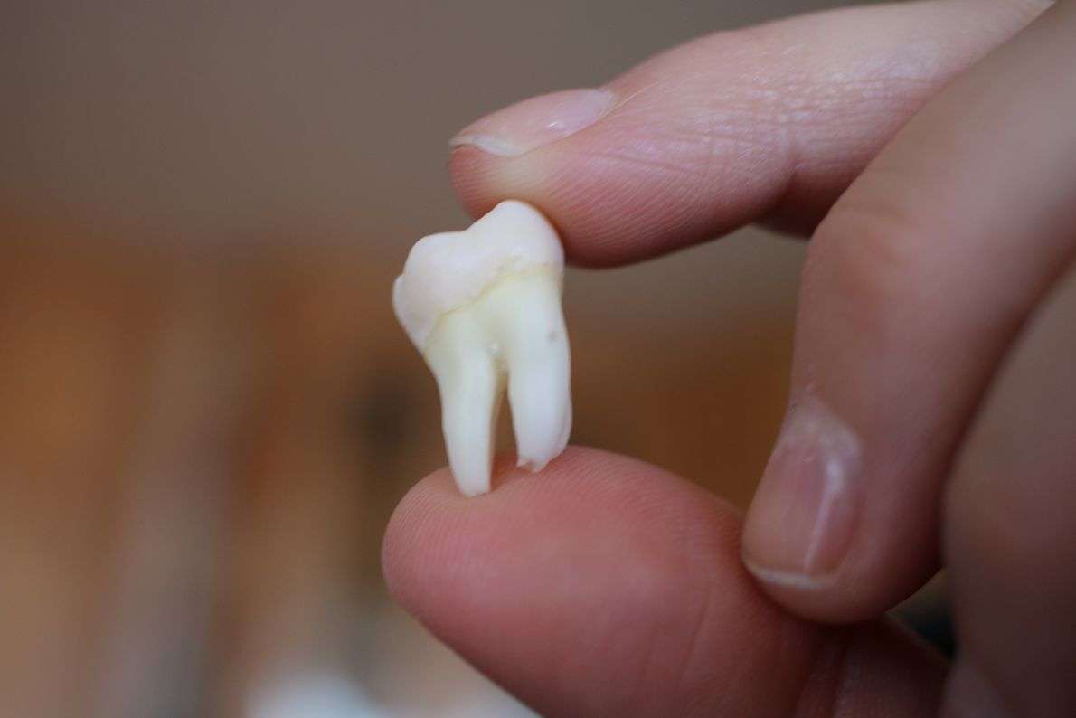 Bleeding After Tooth Extraction: When to Seek Help