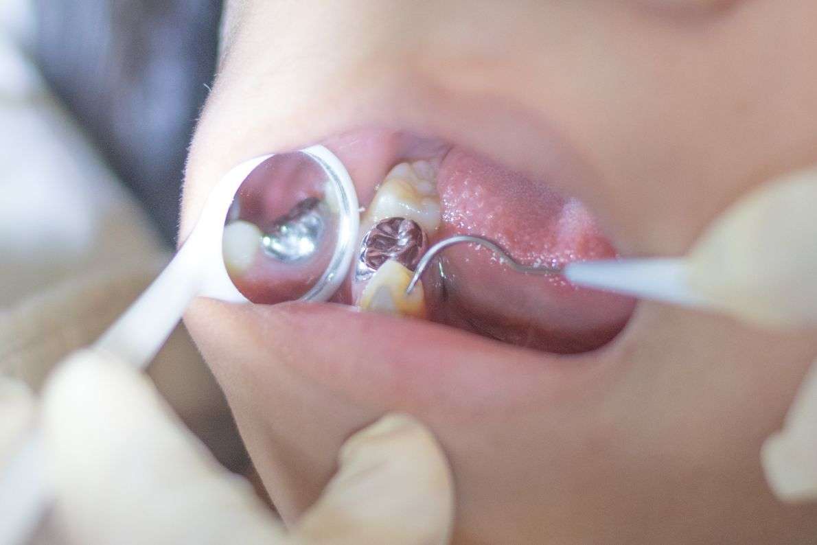 Can Old Amalgam Fillings Be Replaced with White Fillings?