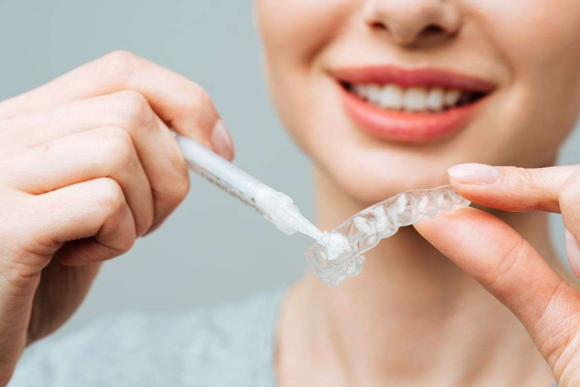 Does Teeth Whitening Work on Crowns or Veneers?