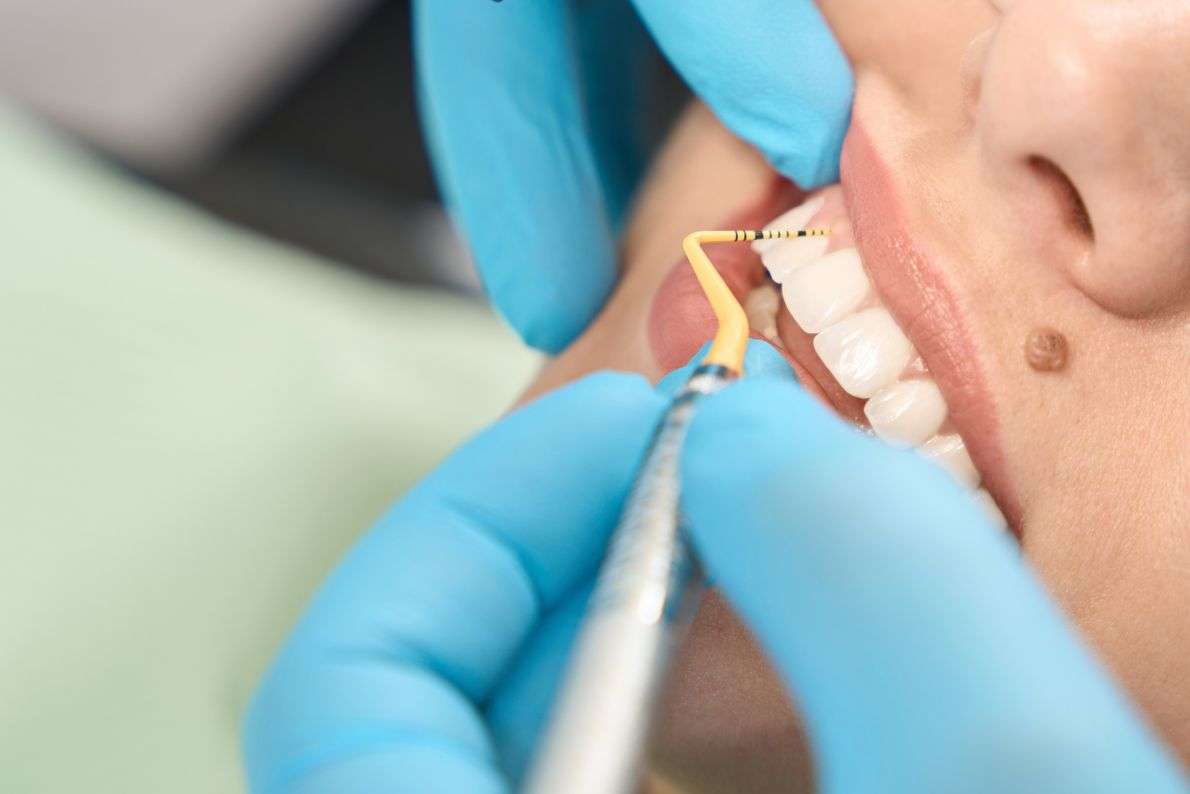 Can a Scale and Polish Remove Stains from Your Teeth?