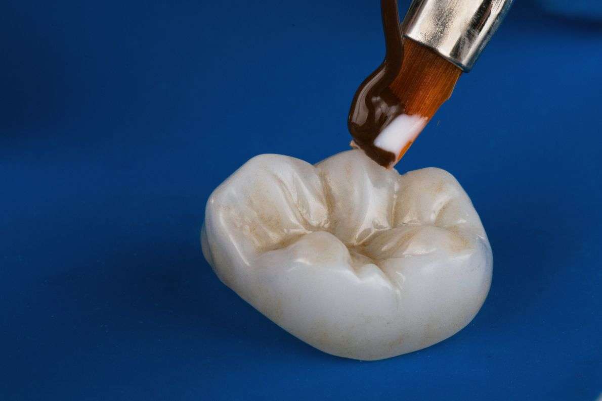 Caring for Your Dental Crown: Tips from StormDental