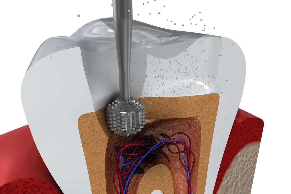 Caring for Your Tooth After Root Canal Treatment