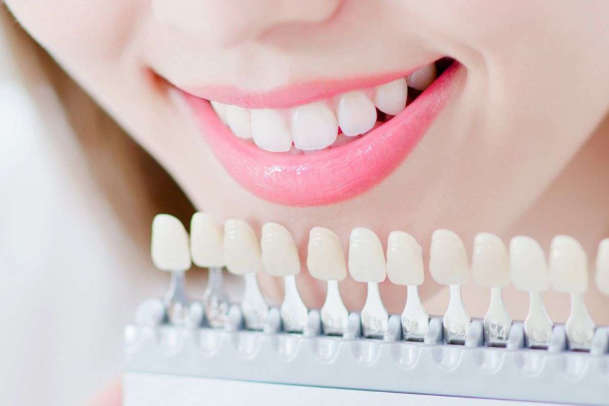 Foods and Habits to Avoid While Using Your Whitening Kit