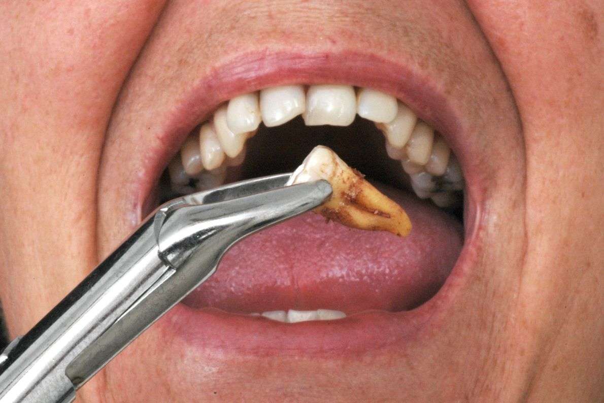 Foods to Eat and Avoid After a Tooth Extraction