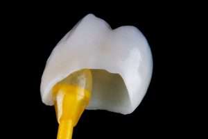 How Advances in Dental Crown Technology Are Improving Outcomes