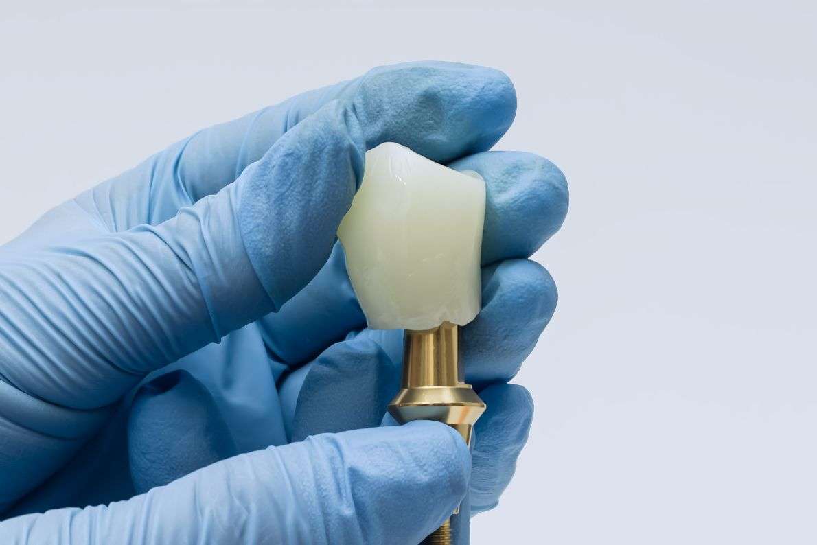 How Long Do Dental Crowns Last and How to Care for Them