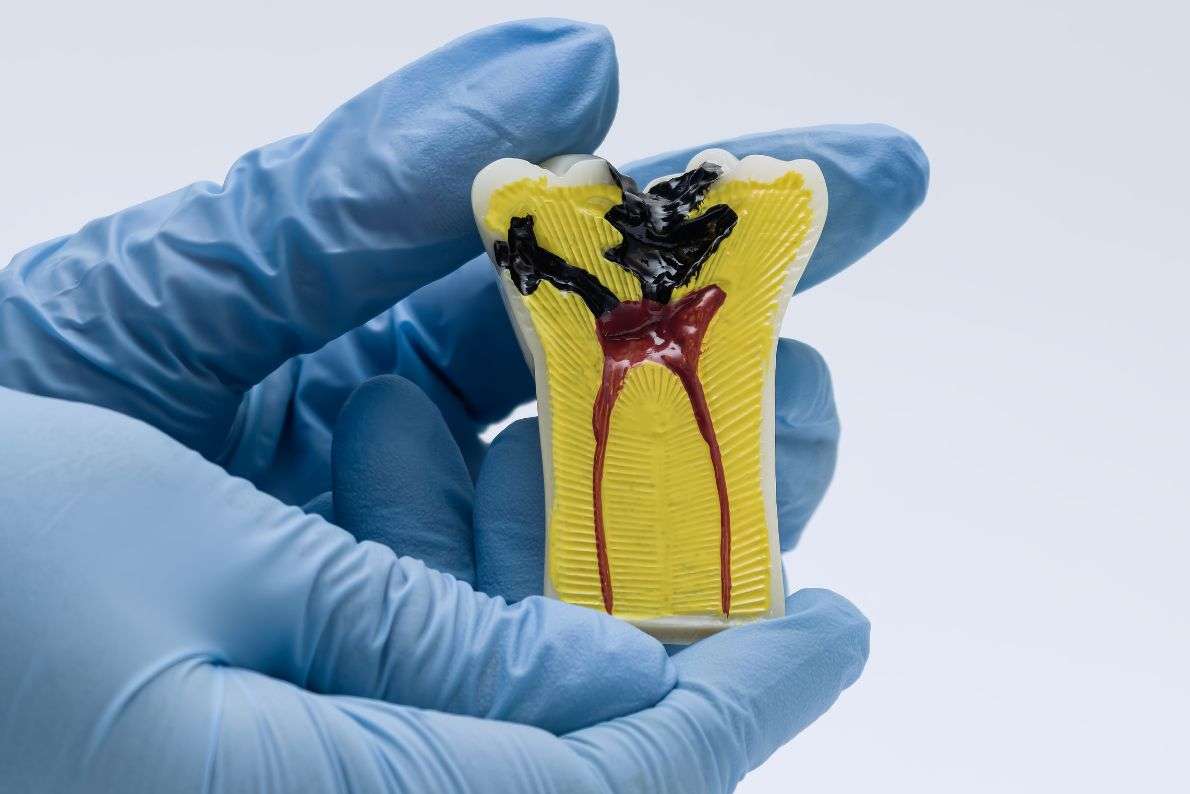 How Many Appointments Does Root Canal Treatment Require?