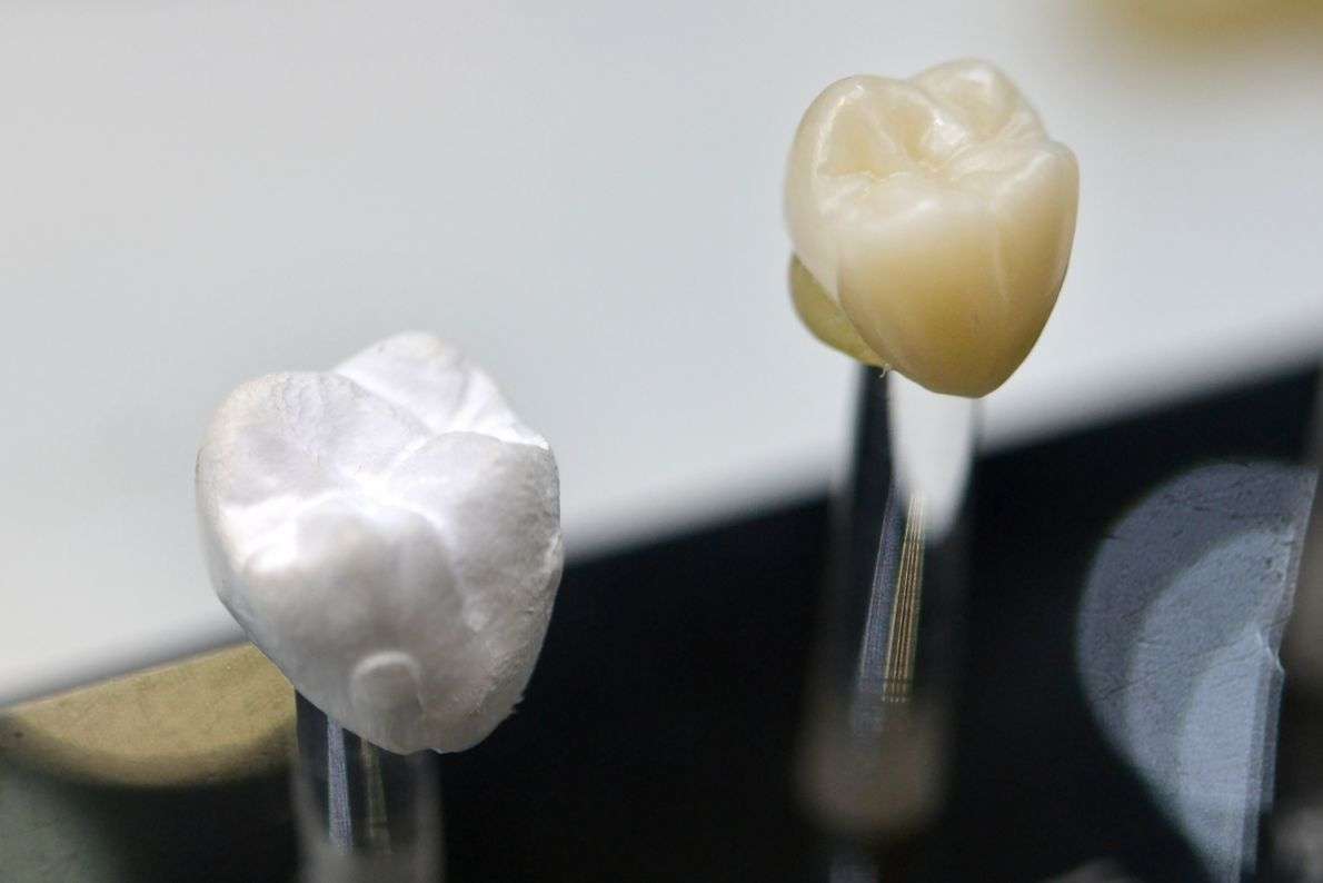 How to Tell If a Dental Crown Needs to Be Replaced