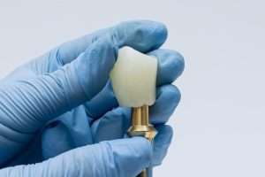 Temporary vs Permanent Dental Crowns: What Is the Difference?