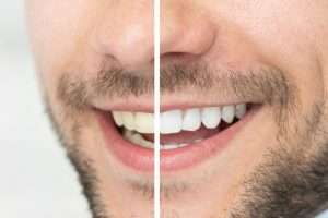 The Difference Between Professional Whitening Gel and Shop-Bought Strips