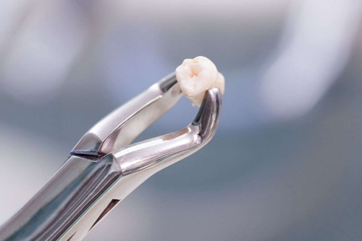 What Are Your Tooth Replacement Options After an Extraction?