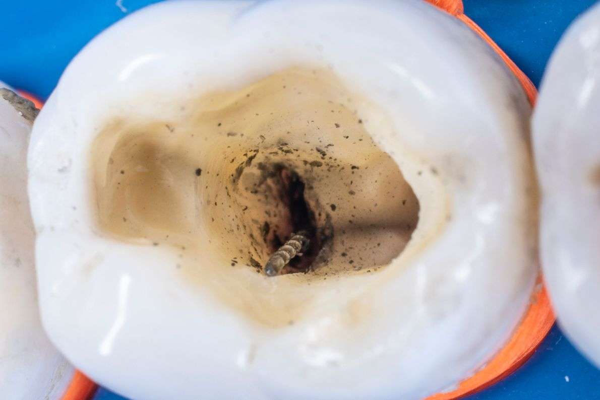 What Causes Tooth Nerve Damage That Leads to Root Canal Treatment?