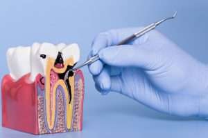 What Happens During a Root Canal Procedure at StormDental?