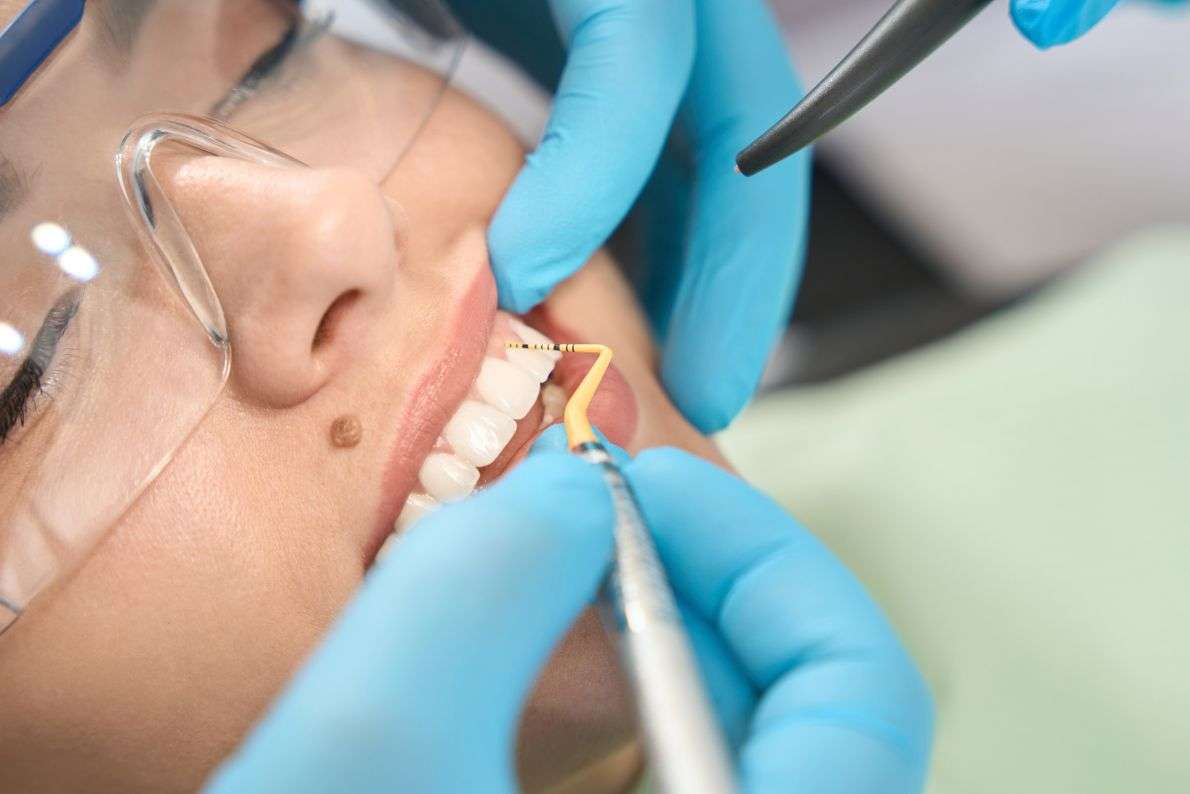 What Happens During a Scale and Polish Appointment at StormDental?