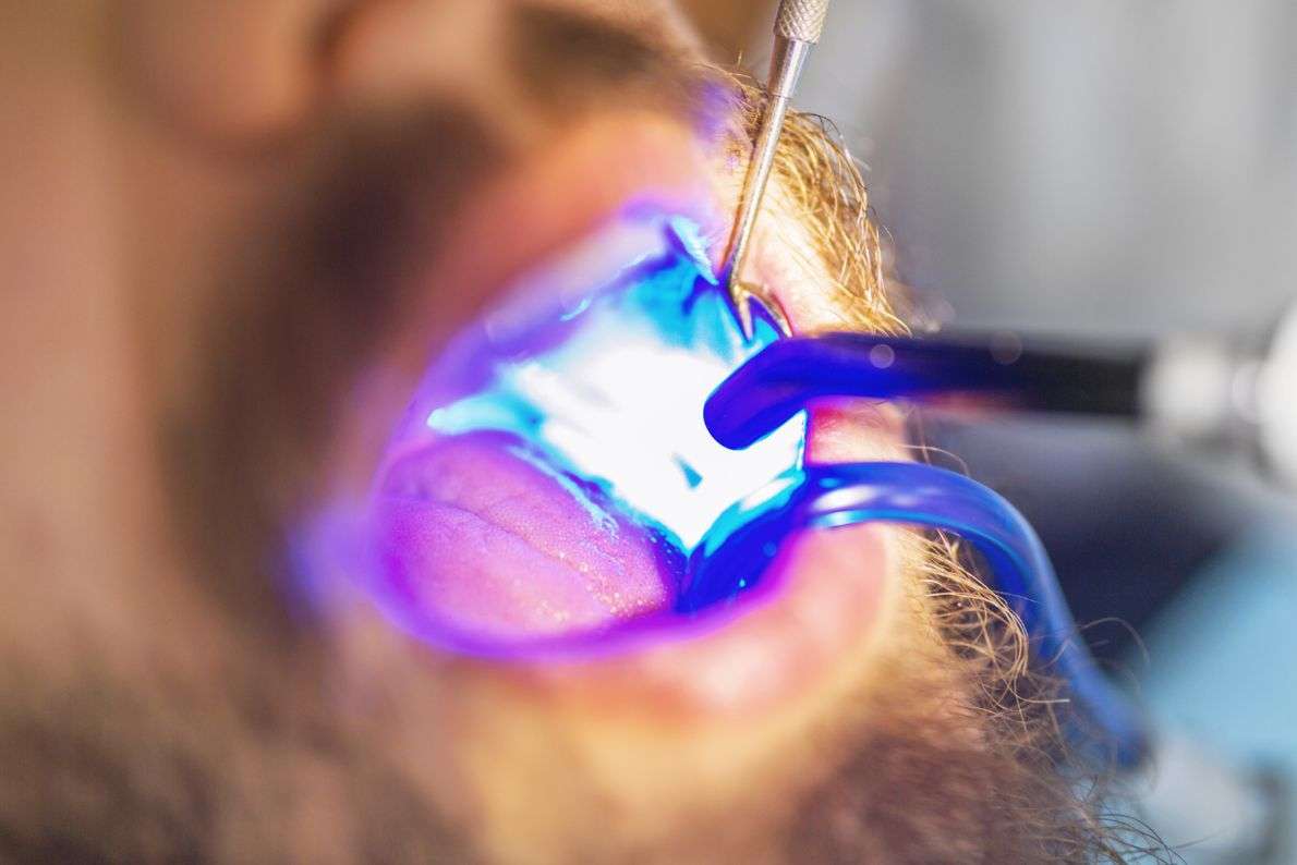 What Happens During a White Filling Procedure at StormDental?